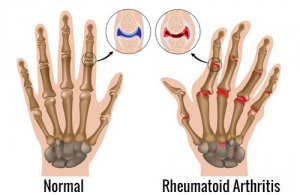 Naturliga behandlingar mot ledgångsreumatism