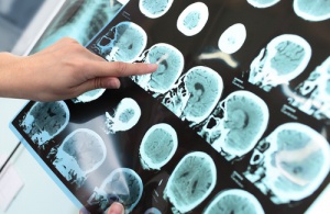 Kan man förebygga Alzheimers, och i så fall hur?