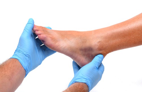 Svullna fötter och vrister - Orsaker och behandling