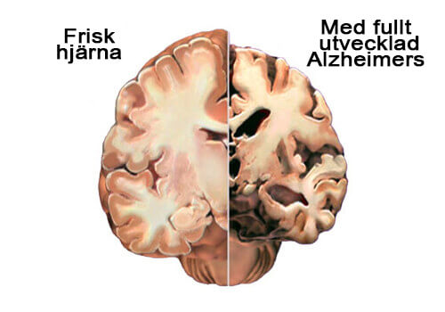 alzheimers i hjärnan