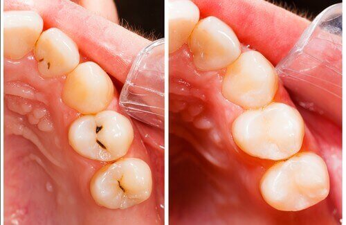 Hål i tänderna: orsaker och naturliga behandlingar