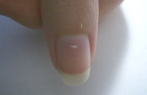 Vad innebär vita fläckar under naglarna?
