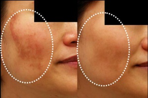 Naturliga behandlingar för melasma