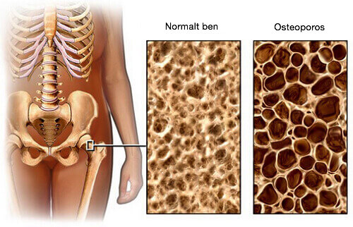 En diet för att förebygga osteoporos En diet för att förebygga osteoporos