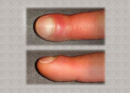 Vilka är orsakerna till svullna fingrar?