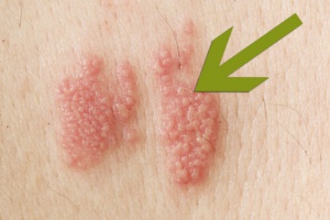 Bältros: vad är det och hur ser det ut?