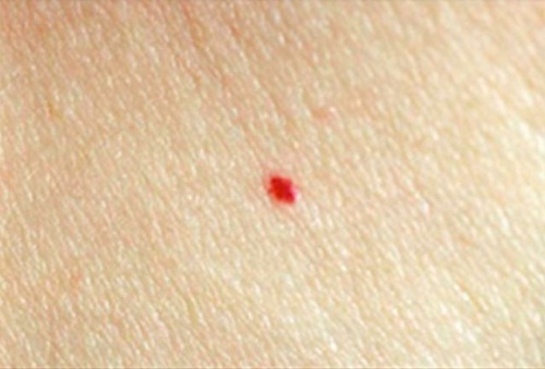 Röda födelsemärken