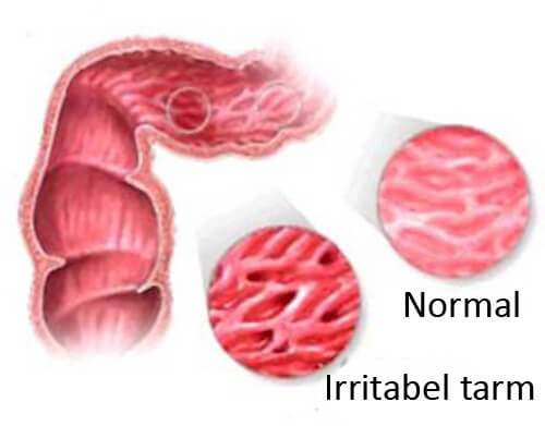 Livsmedel att undvika vid IBS (Irritabel tarm)