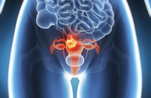 I 60 procent av fallen kan livmodercancer förebyggas