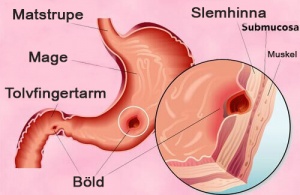 Prova naturliga behandlingar av magsår