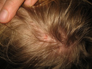 Hur man tar bort löss på ett naturligt sätt