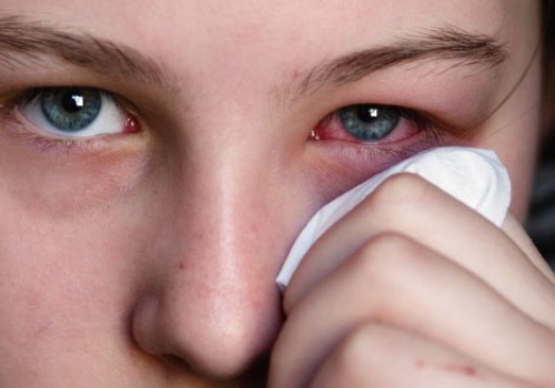 Allergier kan leda till röda ögon