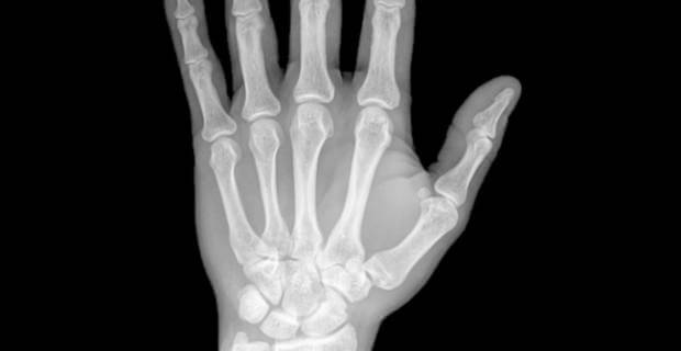 Går det egentligen att bota reumatoid artrit?