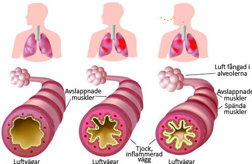 Vad du bör göra om du lider av kronisk astma eller allergi