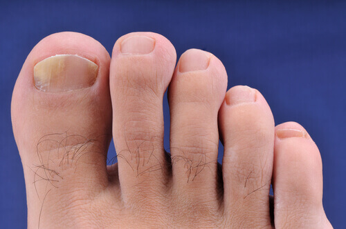 Huskurer för onykomykos (händer & fötter)