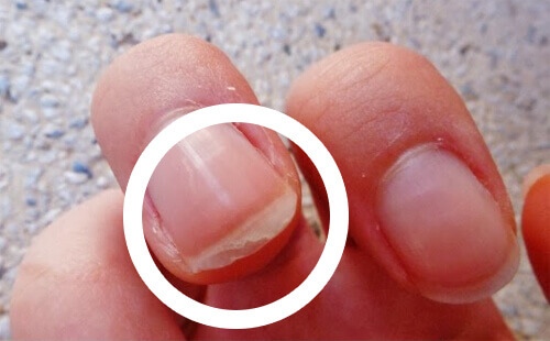 Flagnande naglar? Här är möjliga orsaker och lösningar