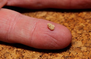 Vilka är egentligen orsakerna till njursten?