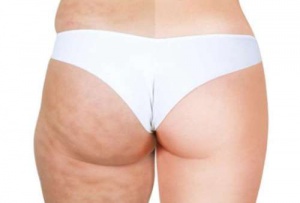 Sex livsmedel som orsakar celluliter