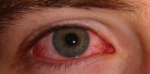 Orsaker och enkla botemedel för röda ögon