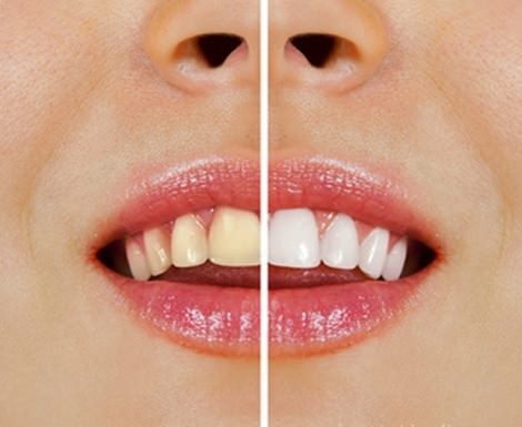 Få vitare tänder med naturliga produkter