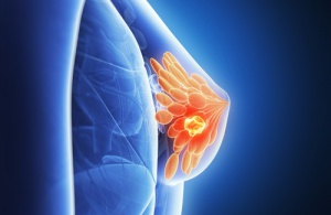 Kan man förutse bröstcancer i ett tidigt skede?