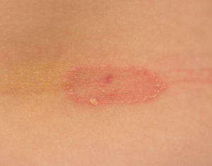 Förhindra fotsvamp; fakta och tips