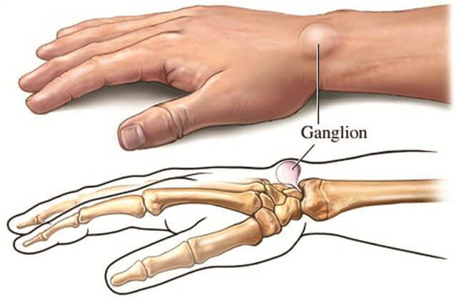 Ganglion