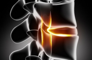 Huskurer för behandling av ischias