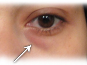 Huskurer mot påsar under ögonen