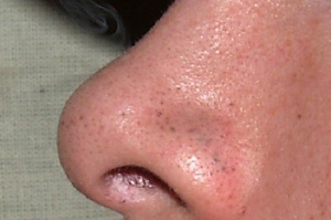 Bli av med pormaskarna - 7 effektiva tips