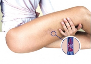 Övningar för att förebygga och behandla åderbråck