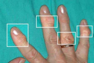 Effektiva och naturliga behandlingar för artrit