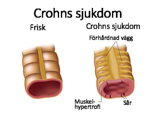 Symtom på och behandling av Crohns sjukdom