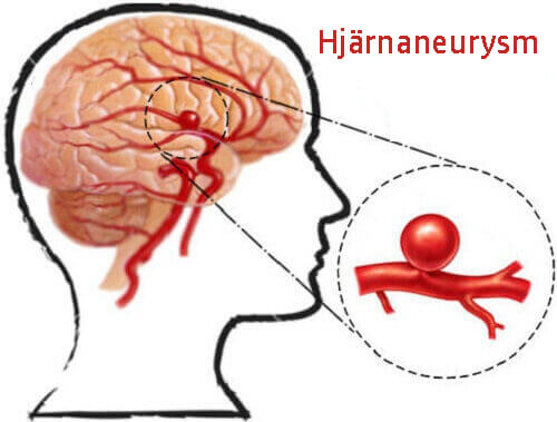 Hjärnaneurysm: Vad det är och hur du kan förebygga det