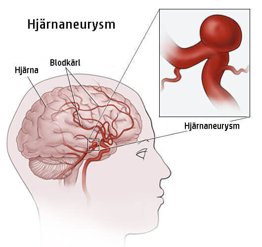 Hjärnaneurysm