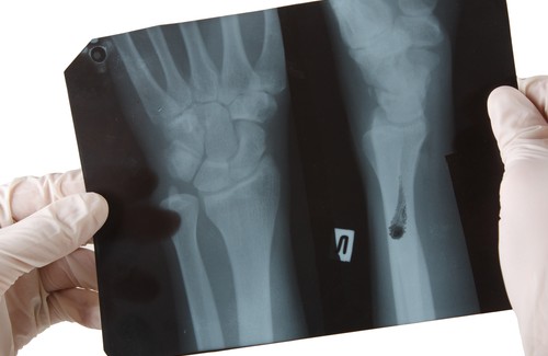 Livsmedel som skadar vår benhälsa