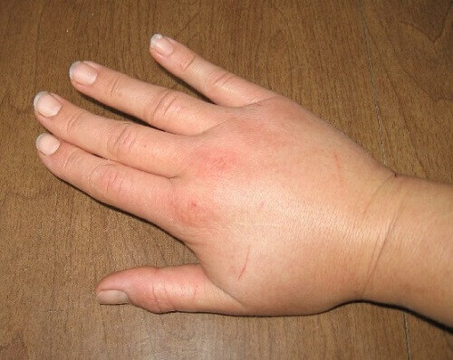 Svullen hand