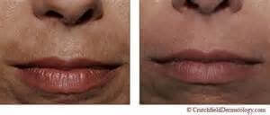 Motverka missfärgningar