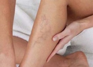 Hur du kontrollerar dålig blodcirkulation