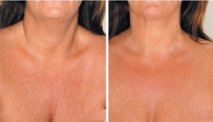 Kurer som minskar halsrynkor