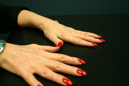 Händerna drabbas ofta