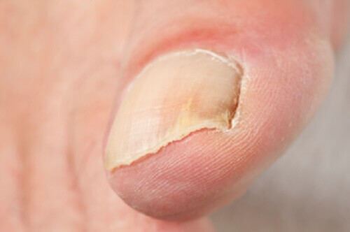 Psoriasis kan visas orsaka förändringar i naglarna