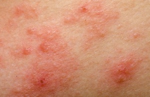 Naturliga behandlingar av rosacea