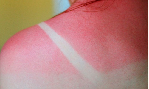 Solbränna – de bästa behandlingarna för huden