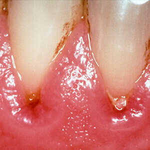 Blödande och svullet tandkött kan orsakas av gingivit