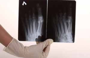 Tips för att lindra fotsmärtor hemma