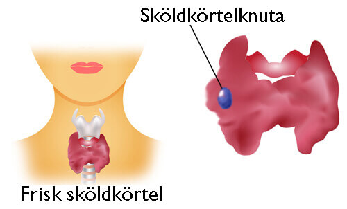 Sköldkörtelknuta