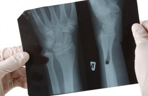 Stärk dina ben med växtbaserat kalcium