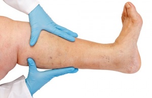 Tio råd för att förhindra vätskeretention