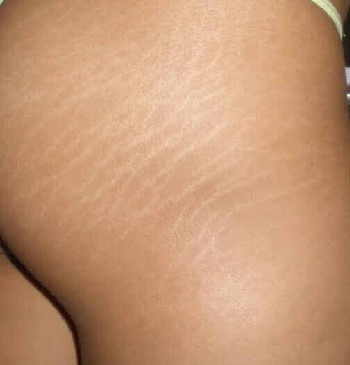 Hudbristningar på lår